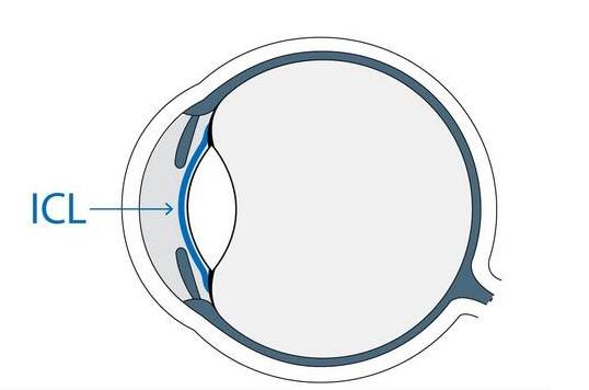 ICL晶体植入术.jpg