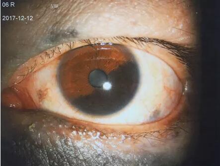 2017年12月11日,脸上“胎记”变恶性肿瘤侵入眼睛的吴先生,在辗转多家医院无从医治的情况下,慕名前来成都新利体育就诊于罗清礼教授。.jpg 2017年12月11日,脸上“胎记”变恶性肿瘤侵入眼睛的吴先生,在辗转多家医院无从医治的情况下,慕名前来成都新利体育就诊于罗清礼教授。.jpg