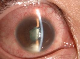 徐先生再也不敢马虎,急忙请假到深圳新利体育就诊。接诊的张小平主任经过仔细检查,得出的诊断是:右眼急性虹膜睫状体炎2.jpg 徐先生再也不敢马虎,急忙请假到深圳新利体育就诊。接诊的张小平主任经过仔细检查,得出的诊断是:右眼急性虹膜睫状体炎2.jpg