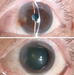 姚颖医生为文先生做了详细检查后,制定了左眼的翼状胬肉切除术、联合自体干细胞移植术、联合羊膜覆盖术的手术方案,这才为他解决了胬肉的麻烦与痛苦。手术一个月后,朋友见了文先生都说他的眼睛 了正常,看不出一点手术过的痕迹2.jpg 姚颖医生为文先生做了详细检查后,制定了左眼的翼状胬肉切除术、联合自体干细胞移植术、联合羊膜覆盖术的手术方案,这才为他解决了胬肉的麻烦与痛苦。手术一个月后,朋友见了文先生都说他的眼睛 了正常,看不出一点手术过的痕迹2.jpg