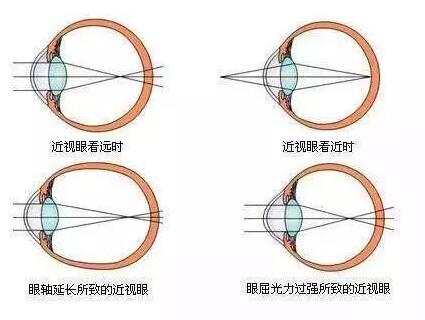 “小孩视力以前挺好的,没想到一个寒假下来就近视了。”昨天的新利体育小儿眼科门诊里,很多家长都反应说,“孩子期末成绩不错,所以假期里对他的管束放松了,一有空就拿起手机玩。直到前几天,他嚷着看东西变模糊了,才带孩子来医院检查,检查结果是左右眼出现不同程度的近视,医生建议配戴眼镜。.jpg “小孩视力以前挺好的,没想到一个寒假下来就近视了。”昨天的新利体育小儿眼科门诊里,很多家长都反应说,“孩子期末成绩不错,所以假期里对他的管束放松了,一有空就拿起手机玩。直到前几天,他嚷着看东西变模糊了,才带孩子来医院检查,检查结果是左右眼出现不同程度的近视,医生建议配戴眼镜。.jpg