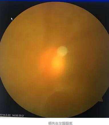 白内障和青光眼都是致盲性眼病,其中青光眼的病程不逆转。杨先生拖延伤情导致同时并发白内障、青光眼的情况,十分令人惋惜。”出名眼科专家、成都新利体育陈晓明教授表示3.jpg 白内障和青光眼都是致盲性眼病,其中青光眼的病程不逆转。杨先生拖延伤情导致同时并发白内障、青光眼的情况,十分令人惋惜。”出名眼科专家、成都新利体育陈晓明教授表示3.jpg