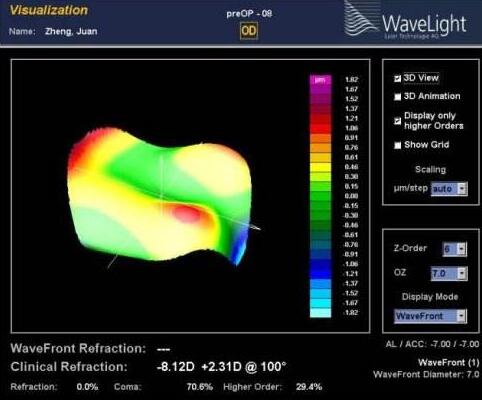角膜地形图引导的个性化角膜屈光手术可采用角膜表层切削手术方式,即角膜表层屈光手术,如PRK、经上皮准分子激光角膜屈光性切削术(Trans-PRK)、乙醇法准分子激光上皮瓣下角膜磨镶术(LASEK)等;也可采用角膜板层屈光手术,如LASIK、飞秒激光辅助LASIK等1.jpg 角膜地形图引导的个性化角膜屈光手术可采用角膜表层切削手术方式,即角膜表层屈光手术,如PRK、经上皮准分子激光角膜屈光性切削术(Trans-PRK)、乙醇法准分子激光上皮瓣下角膜磨镶术(LASEK)等;也可采用角膜板层屈光手术,如LASIK、飞秒激光辅助LASIK等1.jpg