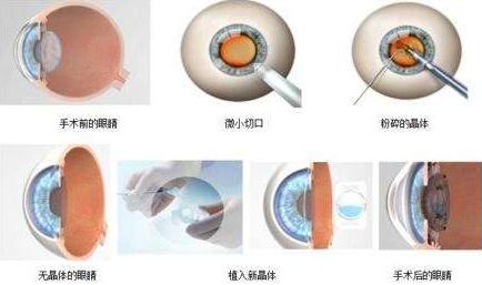 三焦点人工晶体手术原理:置换掉人眼老去的晶体,世代的晶体不仅有非常好的弹性,以往传统的白内障手术只是单纯的脱盲复明手术,更多的是解决患者 远视力。而三焦点人工晶体的问世,彻*解决了传统白内障术后仍需配镜的问题,实现了从以往‘看得见’到‘看得清、看得好’的转变.jpg 三焦点人工晶体手术原理:置换掉人眼老去的晶体,世代的晶体不仅有非常好的弹性,以往传统的白内障手术只是单纯的脱盲复明手术,更多的是解决患者 远视力。而三焦点人工晶体的问世,彻*解决了传统白内障术后仍需配镜的问题,实现了从以往‘看得见’到‘看得清、看得好’的转变.jpg