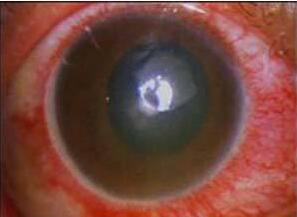 角膜炎.jpg 角膜炎.jpg