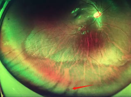 想要摘镜参军在深圳新利体育查出视网膜裂孔 细心妈妈挽救孩子视网膜1.png 想要摘镜参军在深圳新利体育查出视网膜裂孔 细心妈妈挽救孩子视网膜1.png