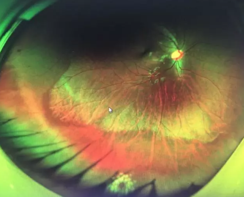 想要摘镜参军在深圳新利体育查出视网膜裂孔 细心妈妈挽救孩子视网膜2.png 想要摘镜参军在深圳新利体育查出视网膜裂孔 细心妈妈挽救孩子视网膜2.png