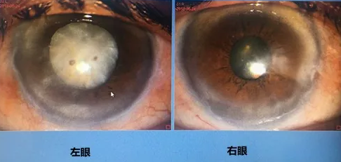 同时患 青光眼、白内障老婆婆辗转几家医院之后终于在成都新利体育顺利手术2.png