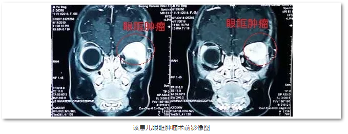 新利体育斜视与小儿眼科主任苏金萍顺利为新生儿摘除眼眶巨大肿瘤1.png