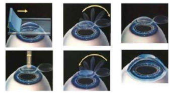 近视无法根治?但你可以这样做?新利体育“有爱就有希望”近视手术火热进行中4.png 近视无法根治?但你可以这样做?新利体育“有爱就有希望”近视手术火热进行中4.png