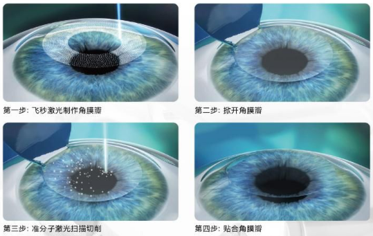 近视无法根治?但你可以这样做?新利体育“有爱就有希望”近视手术火热进行中5.png 近视无法根治?但你可以这样做?新利体育“有爱就有希望”近视手术火热进行中5.png