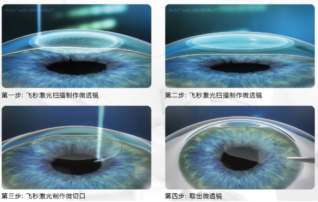 近视无法根治?但你可以这样做?新利体育“有爱就有希望”近视手术火热进行中6.png 近视无法根治?但你可以这样做?新利体育“有爱就有希望”近视手术火热进行中6.png