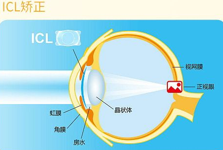 近视无法根治?但你可以这样做?新利体育“有爱就有希望”近视手术火热进行中8.png 近视无法根治?但你可以这样做?新利体育“有爱就有希望”近视手术火热进行中8.png