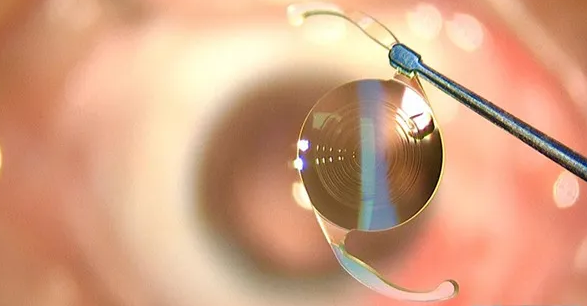 成都新利体育开展了医院首例白内障爱尔康三焦点人工晶体植入术.png 成都新利体育开展了医院首例白内障爱尔康三焦点人工晶体植入术.png