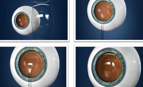 ICL晶体可以使用多久,做完手术会反*吗?新利体育医生这样说1.png ICL晶体可以使用多久,做完手术会反*吗?新利体育医生这样说1.png